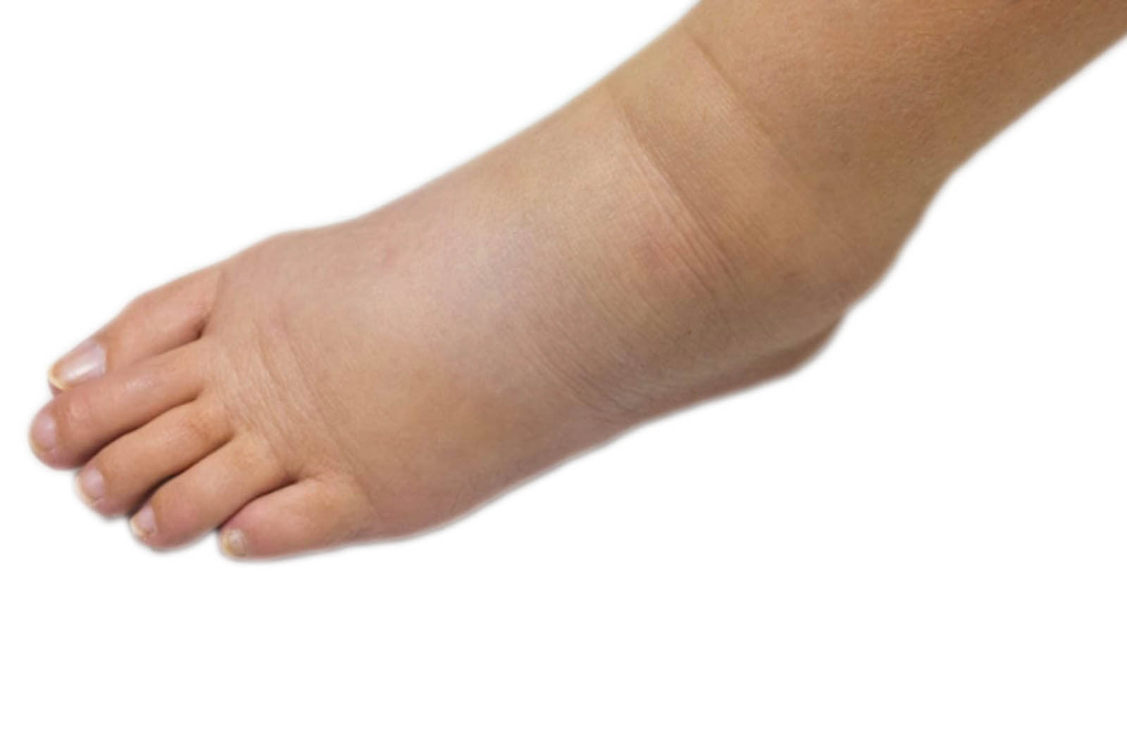 female-foot-with-lymphedema